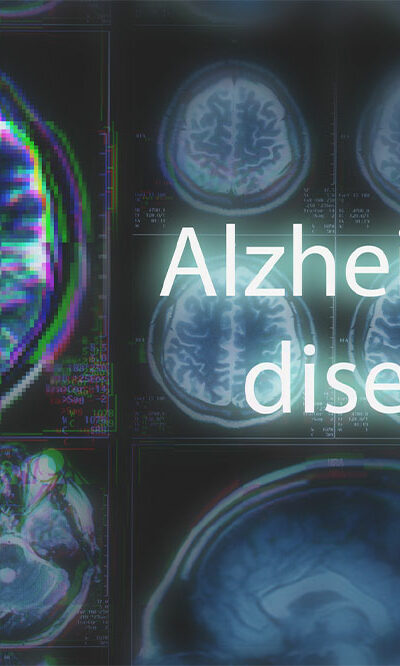 10 Early Signs of Alzheimer&#8217;s Disease