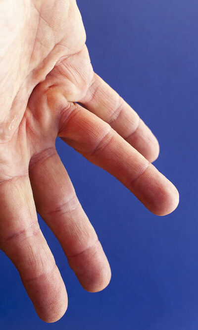 Dupuytren’s Contracture &#8211; Causes, Symptoms, and Home Remedies