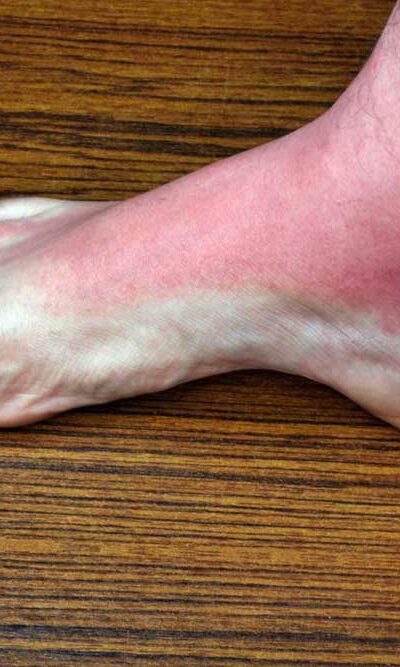 7 Common Causes of Itchy Rashes on Legs