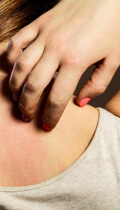 4 common causes that lead to eczema