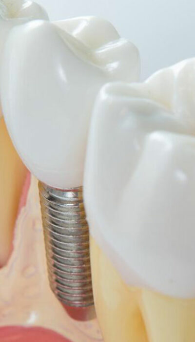 4 practical tips to maintain dental implants for seniors