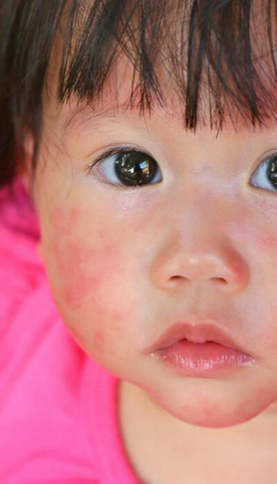 4 useful tips to treatment of atopic dermatitis in children