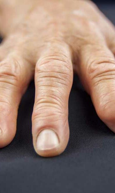 5 Causes of Swollen Fingers