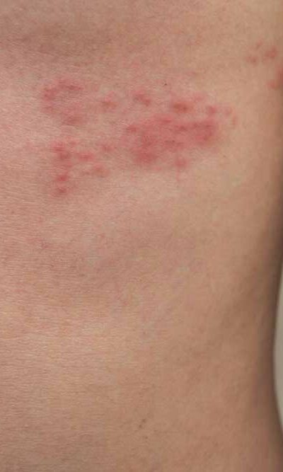 5 Ways to Deal with Shingles Nerve Pain