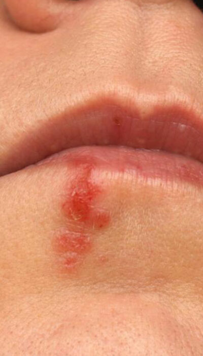 5 natural ways to deal with cold sore