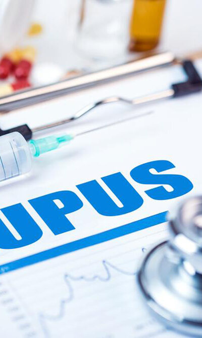 5 things to know about Lupus