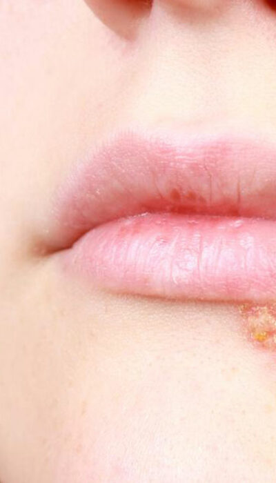 5 useful home remedies to get relief from cold sores