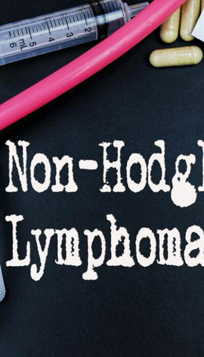 6 common risk factors for Non-Hodgkin lymphoma