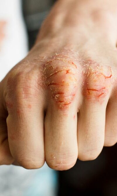 9 solutions for managing psoriasis flare-ups