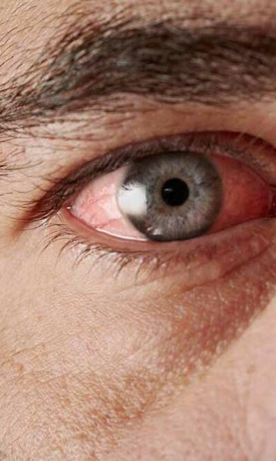 Common Causes of Blood Vessel Burst in the Eye