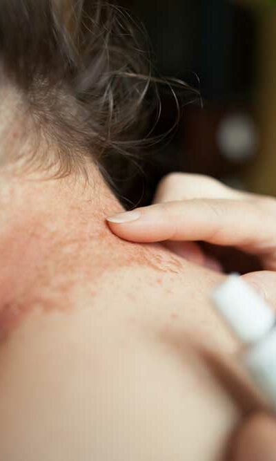 Common Signs and Symptoms of Eczema