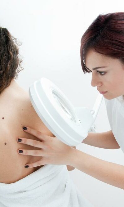 Common Signs and Symptoms of Melanoma