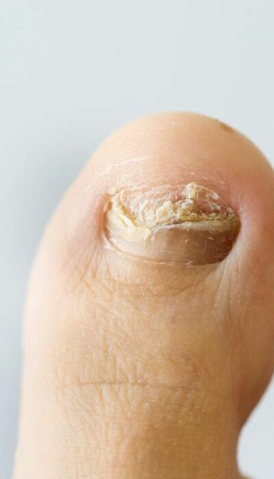 Common nail infections to avoid