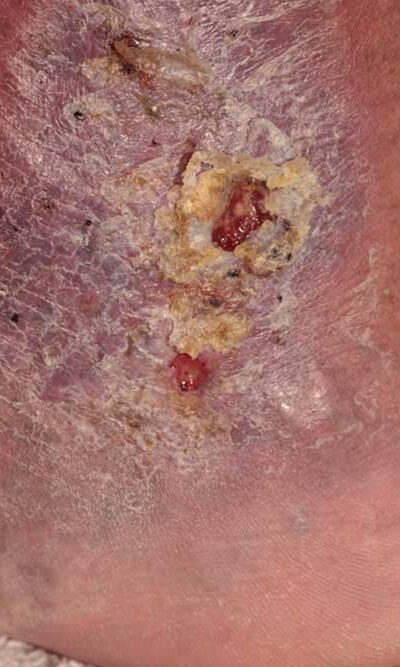 Causes and Symptoms of Cellulitis