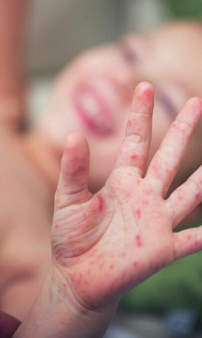 Causes and symptoms of Hand-foot-and-mouth disease