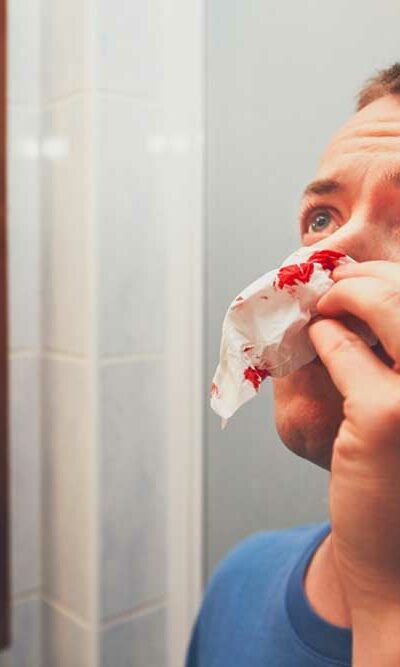 Causes of Nose Bleeding and How to Cure It