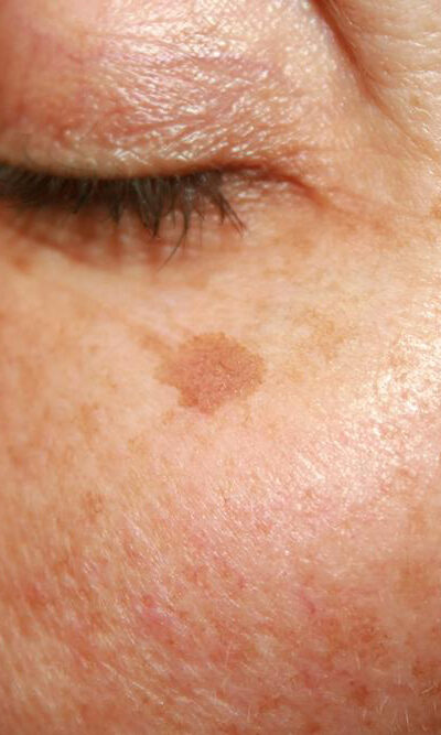 Cheap, effective remedies lighten age spots naturally