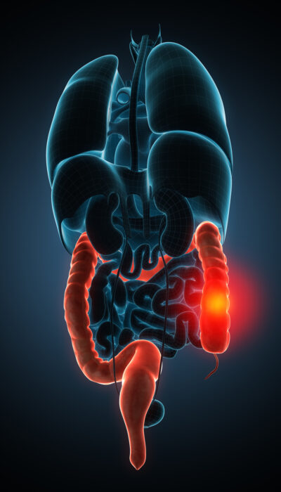 Crohn’s Disease Common Signs and Symptoms