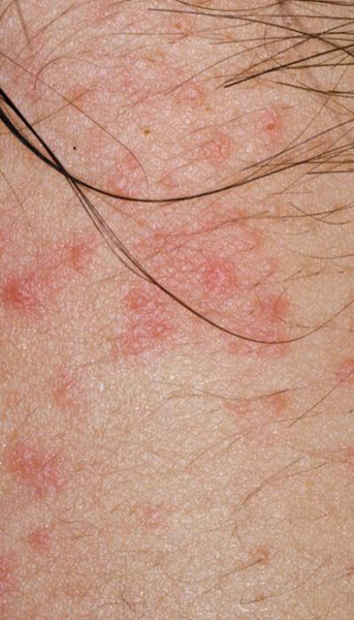 Curious about atopic dermatitis? Here&#8217;s what you need to know