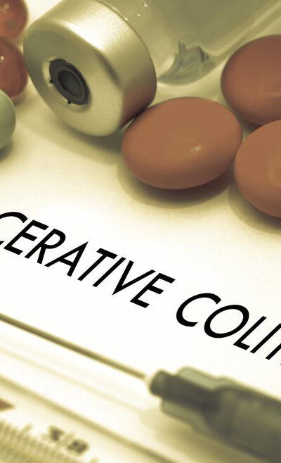 An overview for the treatment of Ulcerative Colitis