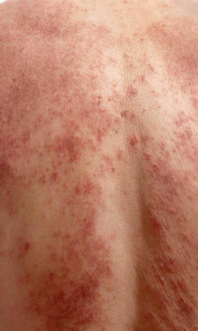 A few quick ways to identify chickenpox infection