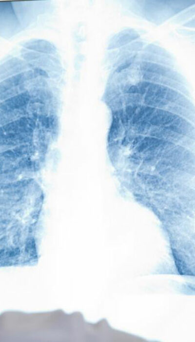 A few things you should know about mesothelioma cancer