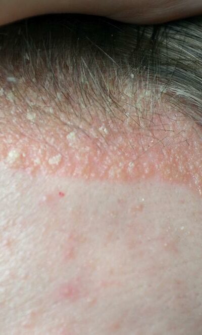 All you need to know about scalp psoriasis