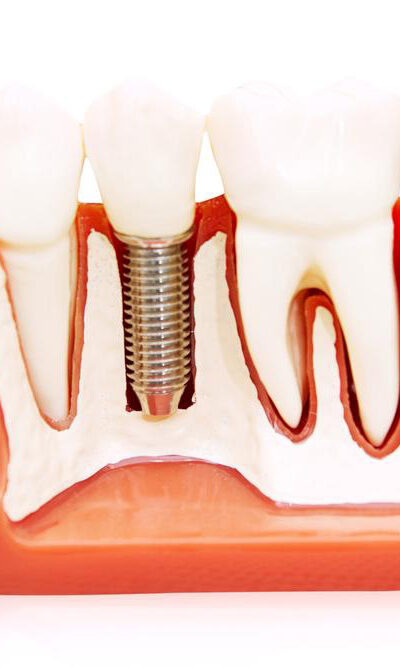 All you need to know about permanent dentures