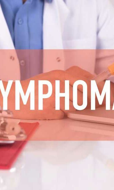 Best Treatment Options for Non Hodgkin Lymphoma