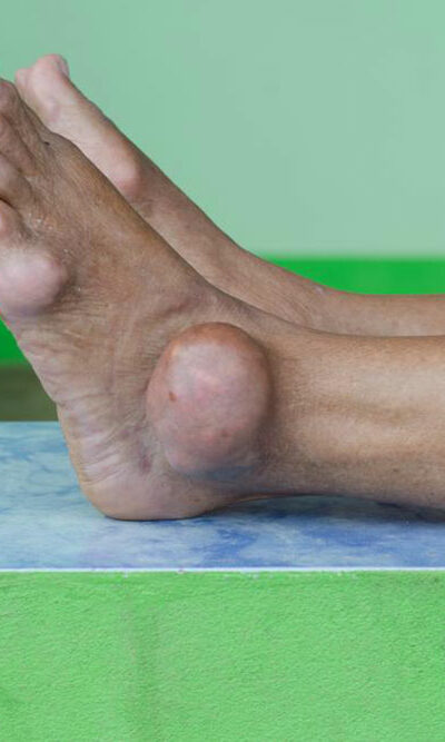 Gout attacks and their treatment procedures