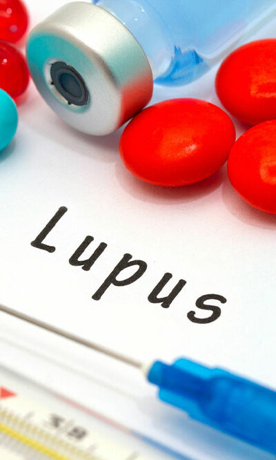 General Procedures Involved in Lupus Management