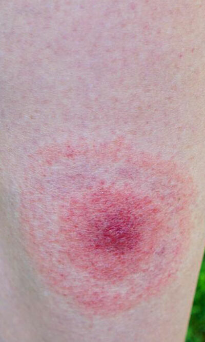 Early signs of lyme disease