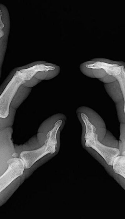 Early signs of rheumatoid arthritis and how to catch them