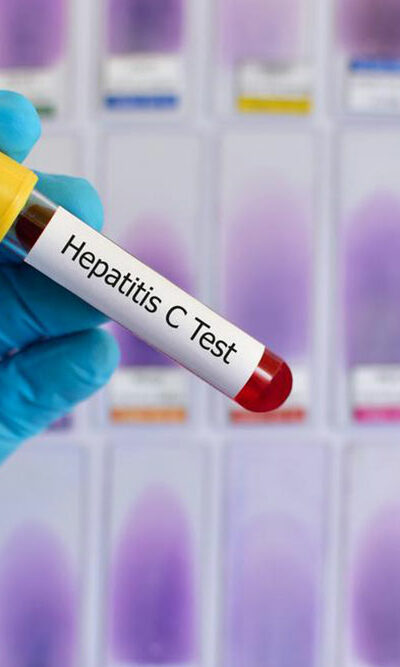 Early signs and symptoms of Hepatitis C