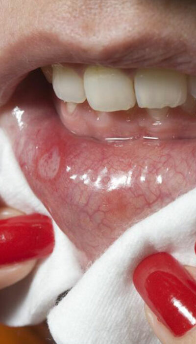 Effective ways to prevent cold sores