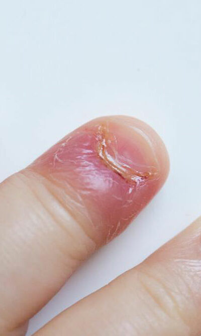 Four reasons for swollen finger pain