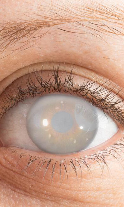 Five facts to know about cataract and its surgery