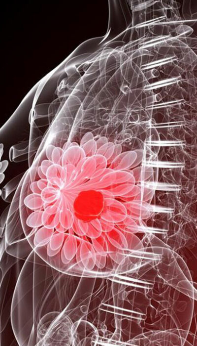 Five things you need to know about breast cancer