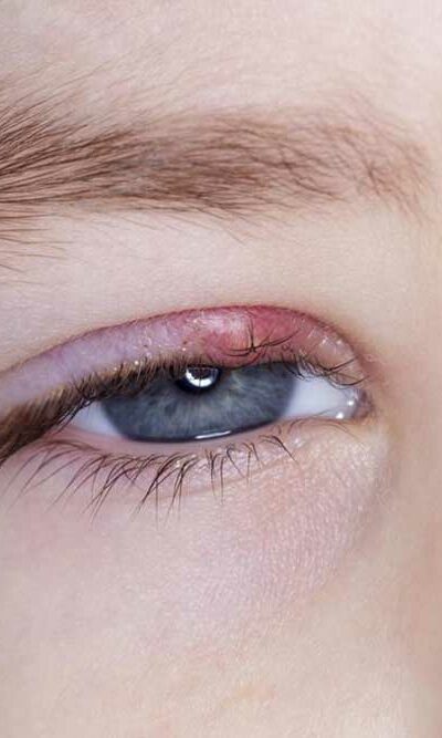 Know about the Symptoms and Causes of Eyelid Inflammation