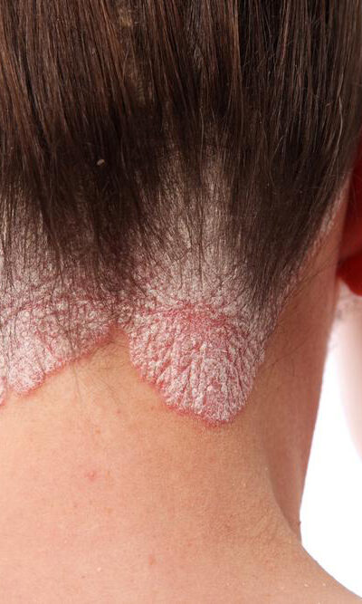 Know the skin ailment: Scalp psoriasis