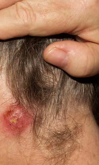 How can you spot the signs of staph infection