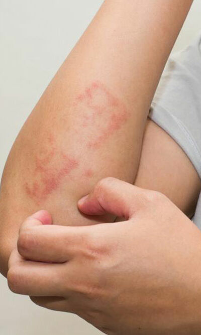 How to identify and treat poison ivy rash with daily use products