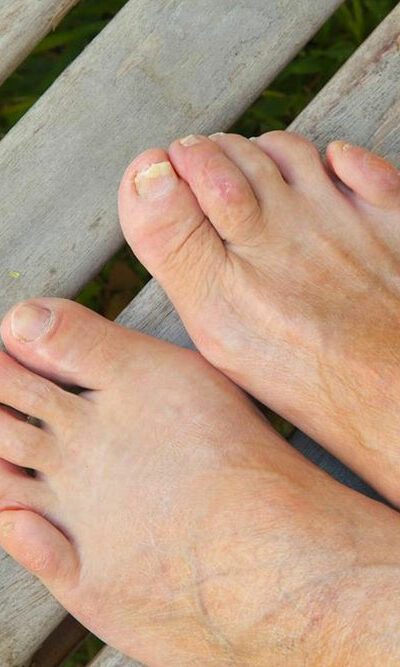 Home remedies for curing toenail fungus