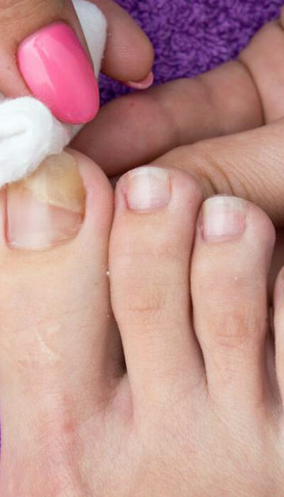 Home remedies for toe nail fungus