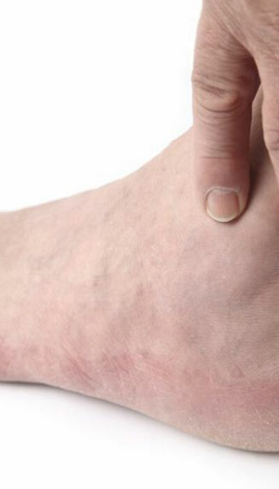 Home treatment for relief from gout foot pain