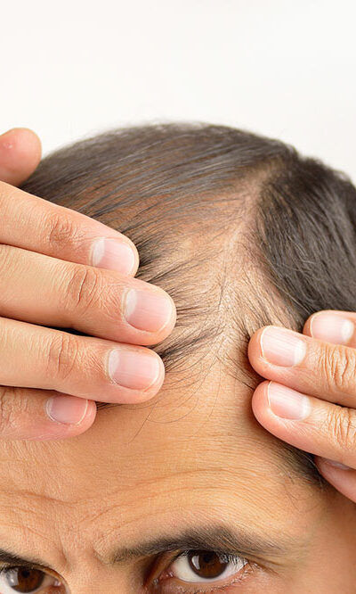 Hair loss – Its symptoms and causes