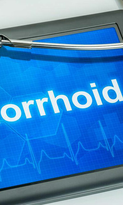 Hemorrhoids: What they are and their causes