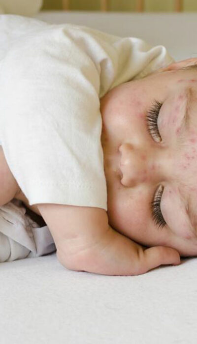 Here&#8217;s how to treat skin rashes in babies