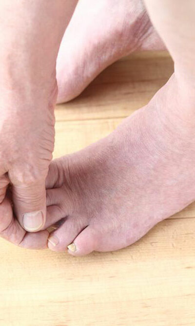 Important things to know about toenail fungus