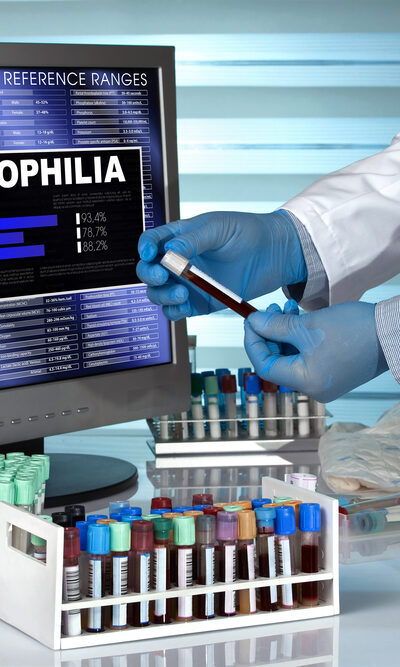 Overview: Hemophilia A and Hemophilia B